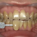 30代女性　歯の黄ばみが濃くホワイトスポットありの症例