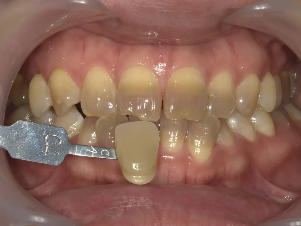 テトラサイクリン使用後に歯を再び白くする最良の方法は何ですか?